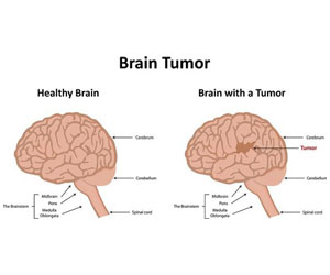 brain tumor treatment in Hyderabad