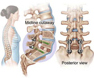 Lumbar Spine Surgery in Hyderabad