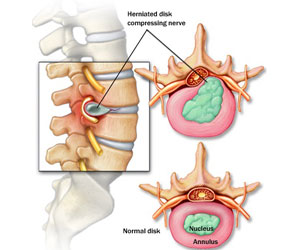 spine surgery for back pain in hyderabad